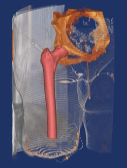 A screw anchored intramedullary hip stem